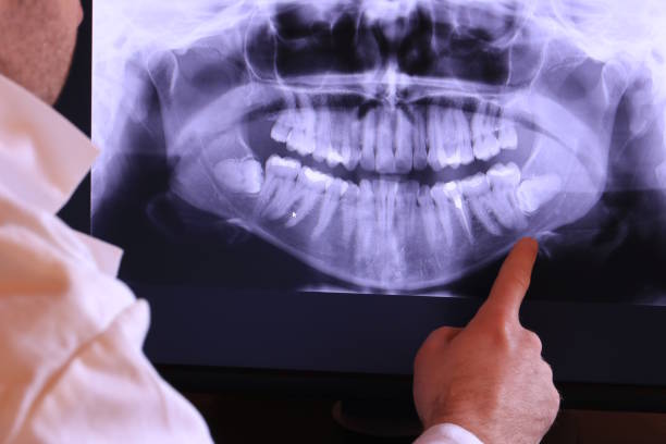 Best Emergency Wisdom Tooth Extraction in Pleasant Run, OH